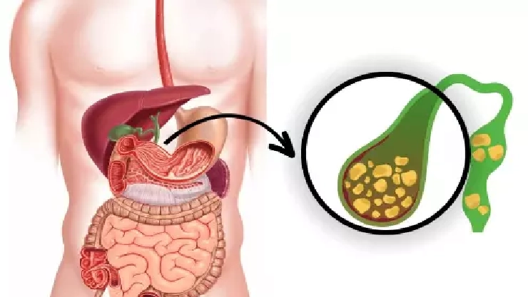 பித்தப்பை கல்லை இயற்கை வழியில் அகற்றுவது எப்படி ?